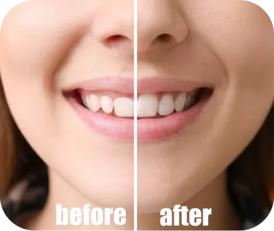 Cosmetic tooth contouring procedure