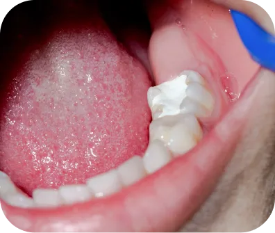 Dental fillings procedure