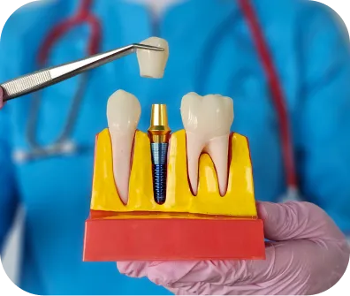 Dental implant restoration