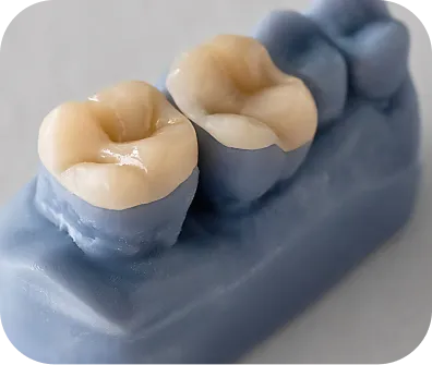 Dental inlays and onlays