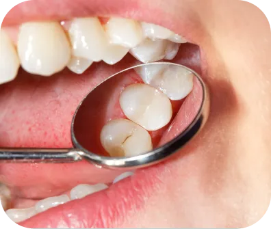 Dental sealants application