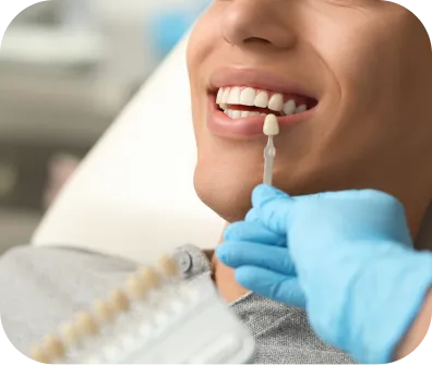 Dental veneers procedure