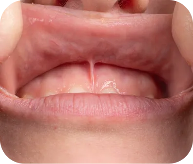 Frenectomy procedure