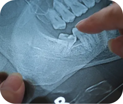 Wisdom teeth removal